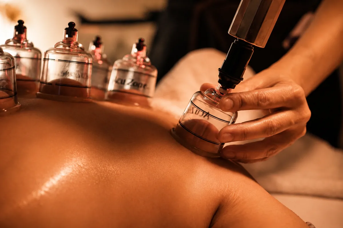 Therapist applying suction cups during a cupping session